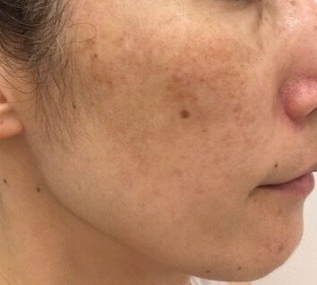 美容皮膚医学BEAU 30 とことん肝斑裁断済 肝斑とシミを肌診断機「re-Beau2（レビュー）」で詳細に解析！ | 三木市の皮膚科・美容皮膚科 さかい皮フ科クリニック