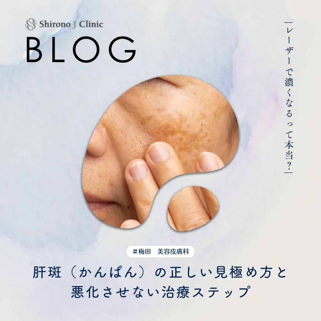 2026年5月29日_レーザーで濃くなるって本当？肝斑（かんぱん）の正しい見極め方と悪化させない治療ステップ